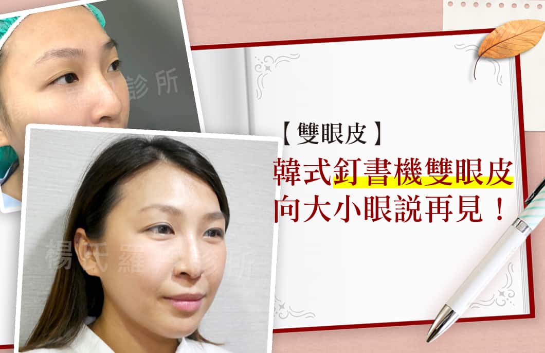 【雙眼皮】韓式釘書機式雙眼皮，向大小眼說再見！